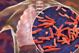 Mengenali Gejala Tuberkulosis (TBC) Dan Olahraga yang Baik untuk Pengidap TBC