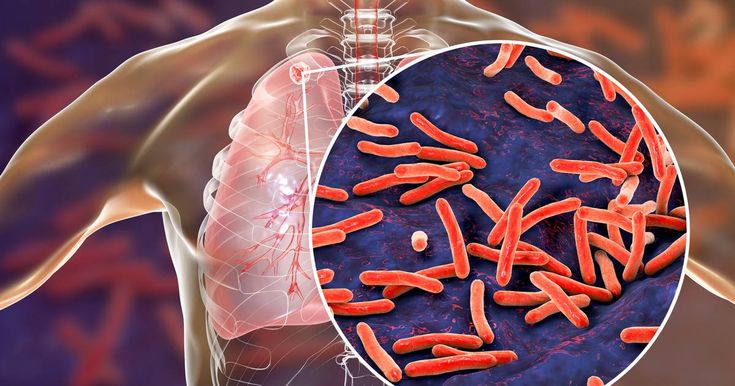 Mengenali Gejala Tuberkulosis (TBC) Dan Olahraga yang Baik untuk Pengidap TBC